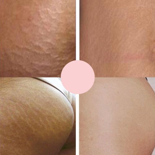 Stretch marks affect 70% of the adult population, whether they are stretch marks in men or stretch marks in women. The vast majority have stretch marks of one type or another in one or more areas of their body.